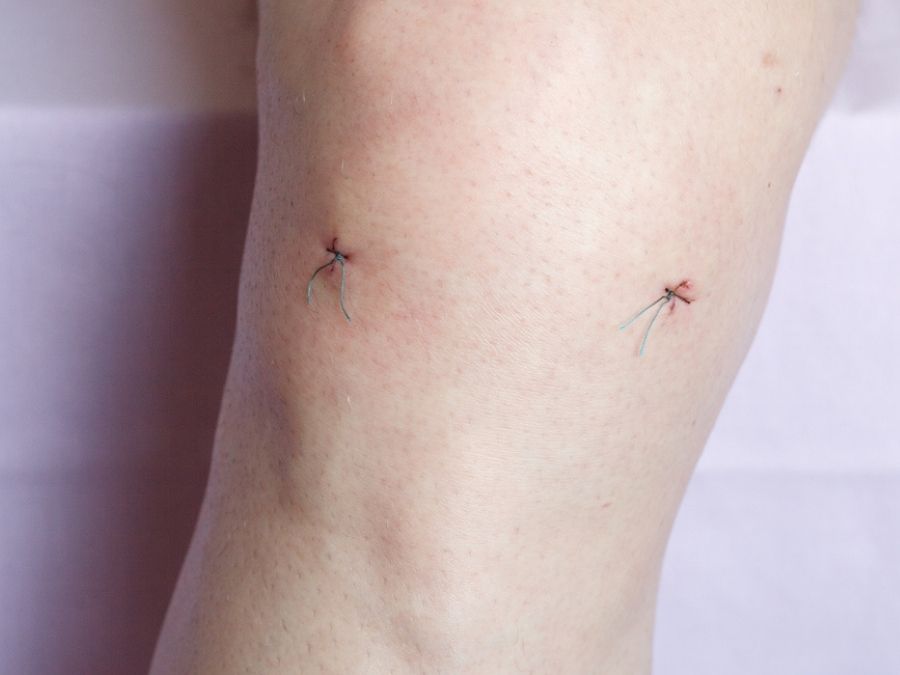 meniscectomia selettiva