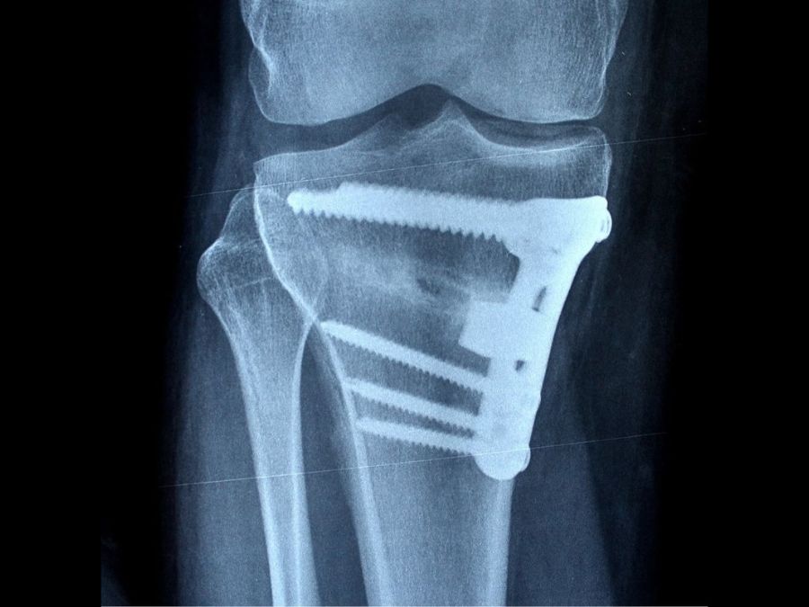 Osteotomia la chirurgia corregge il ginocchio